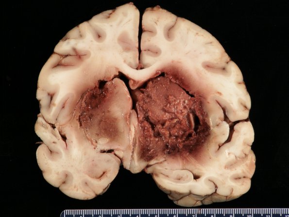 1B3 Mucor (Zygomycetes) (Case 1)_7 - Copy