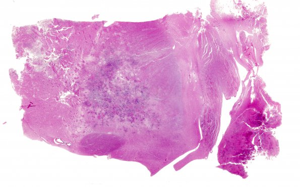 1C1 Mucor (Zygomycetes) (Case 1) H&E whole mount - Copy