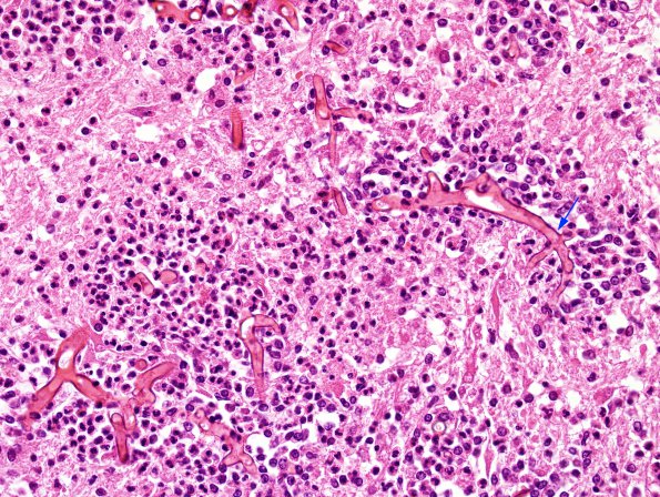 1C3 Mucor (Zygomycetes) (Case 1) H&E 4 copy