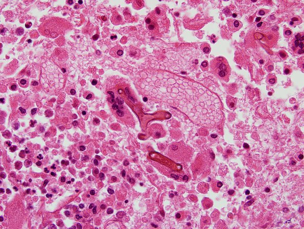 1C5 Mucor (Zygomycetes) (Case 1) H&E 6