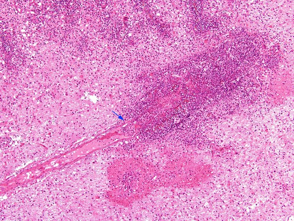 1C6 Mucor (Zygomycetes) (Case 1) H&E A9 copy