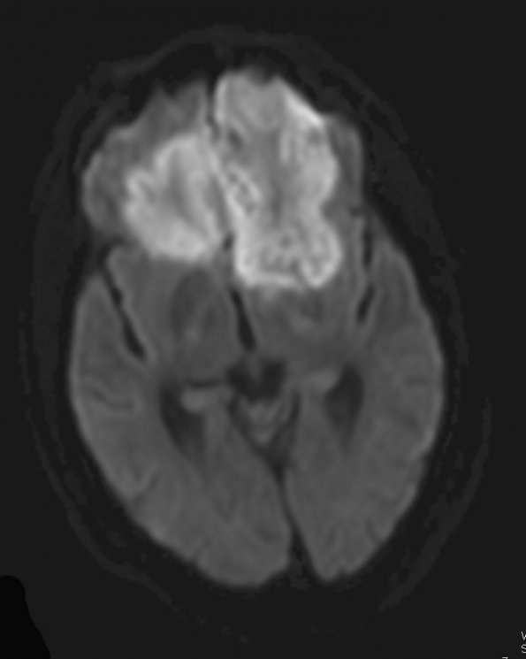 2A2 Mucormycosis (Case 2) DIFFUSION TRACE W 2 - Copy