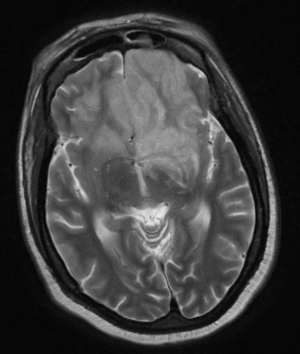 2A3 Mucormycosis (Case 2) T2 - Copy