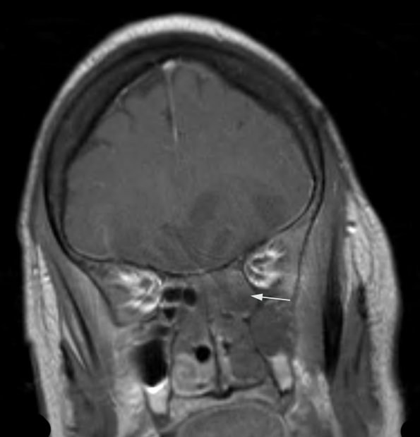 2A5 Mucormycosis (Case 2) T1 W 2 - Copy copy