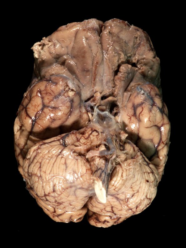 2B1 Mucormycosis (Case 2) 4