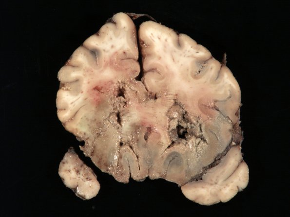 2B2 Mucormycosis (Case 2) 9