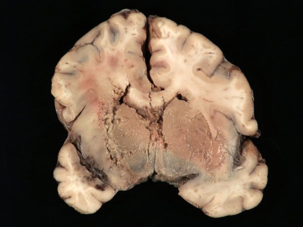 2B3 Mucormycosis (Case 2) 10