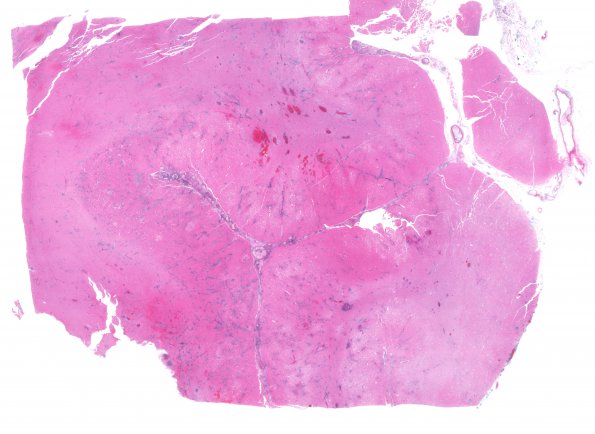 2C1 Mucormycosis (Case 2) H&E whole mount