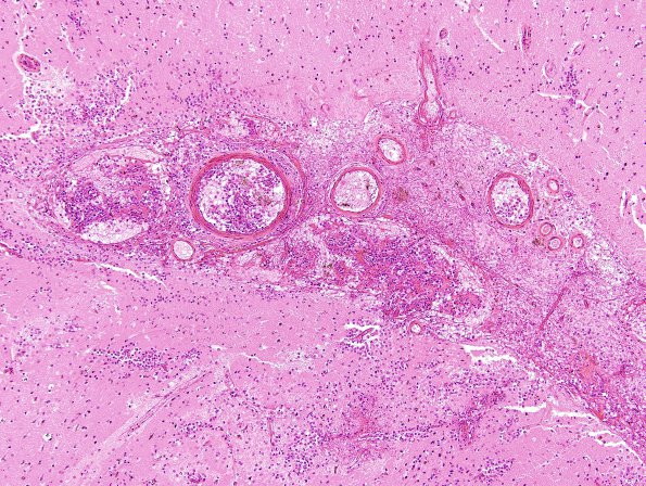 2C2 Mucormycosis (Case 2) H&E 3