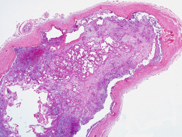 2C4 Mucormycosis (Case 2) MCA H&E 3