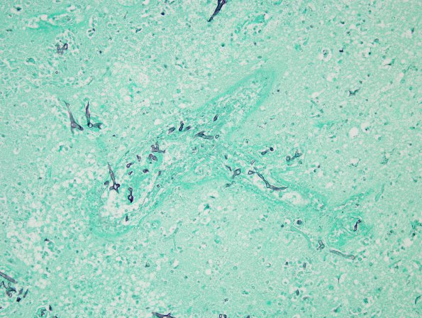 2D1 Mucormycosis (Case 2) GMS 3