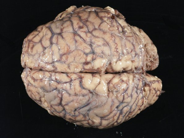 3A1 Mucormycosis (Case 3) gross_3