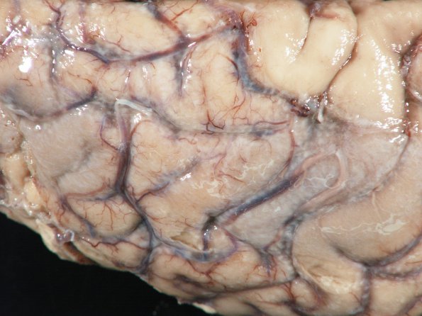 3A2 Mucormycosis (Case 3) gross_4