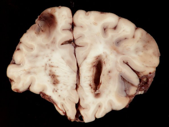 3A3  Mucormycosis (Case 3) gross_6