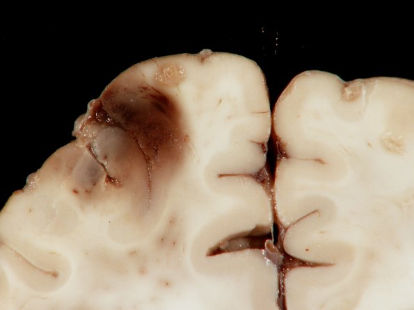 3A4 Mucormycosis (Case 3) gross_7