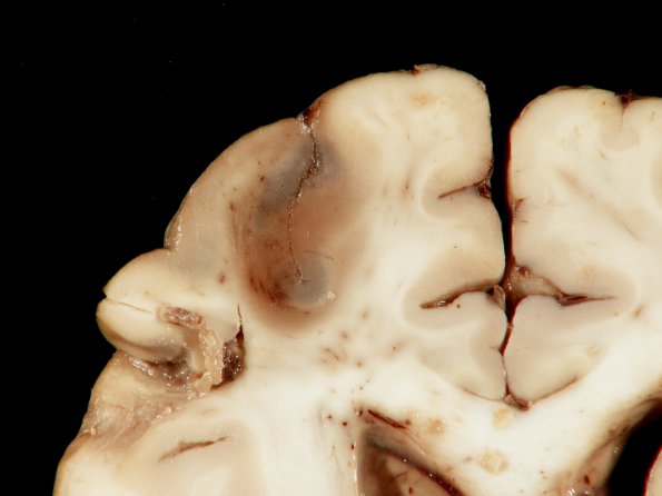 3A5 Mucormycosis (Case 3) gross_8