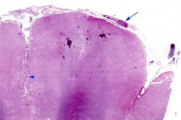 3B1 Mucormycosis (Case 3) H&E whole mount (Embolic) copy