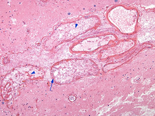 3B2 Mucormycosis, embolic (Case 3) H&E 4 copy