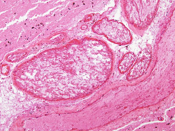 3B3 Mucormycosis, embolic (Case 3) H&E 2