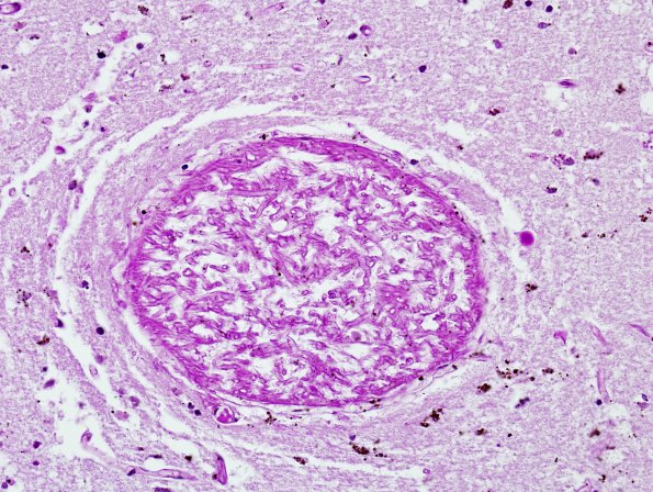 3C2 Mucormycosis (Case 3) PAS 3