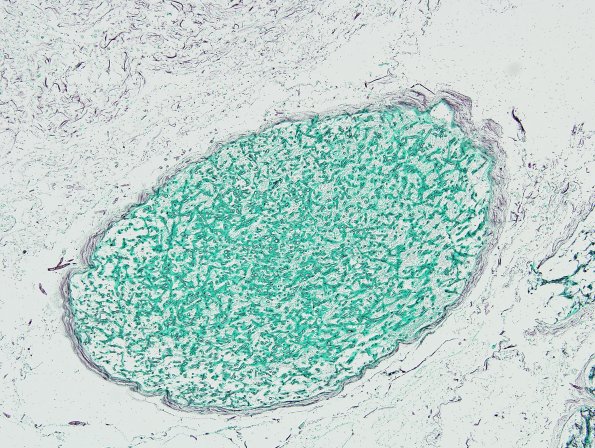 3C4 Mucormycosis (Case 3) GMS 6