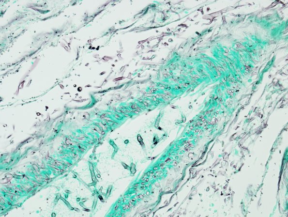 3C5 Mucormycosis (Case 3) GMS 2