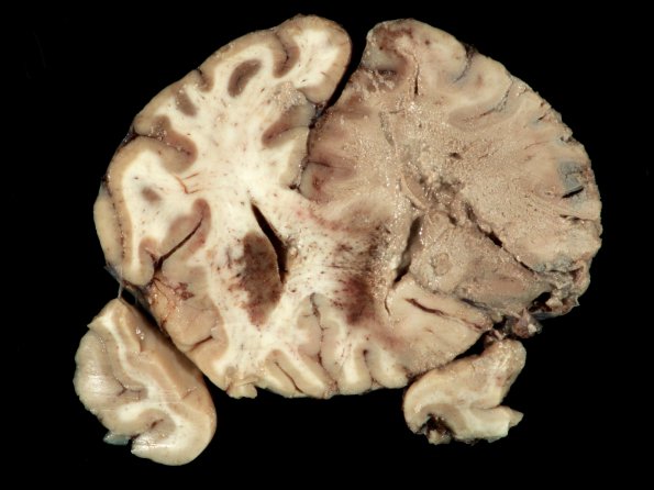 4A2 Mucormycosis (Rhizopus) (Case 4) gross_5