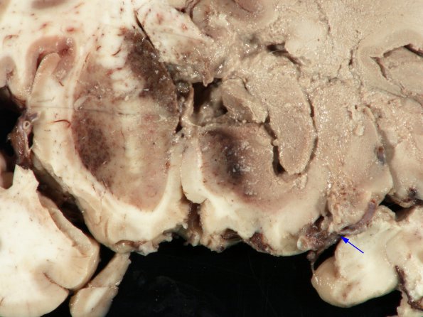 4A4 Mucormycosis (Rhizopus) (Case 4) gross 5A copy