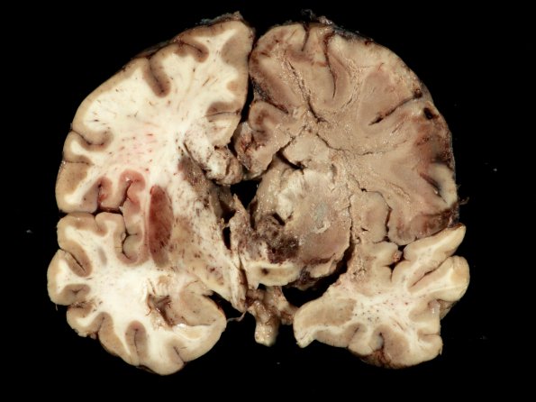 4A5 Mucormycosis (Rhizopus) (Case 4) gross_7