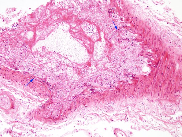 4B1 Mucormycosis (Rhizopus) (Case 4) H&E 17 copy