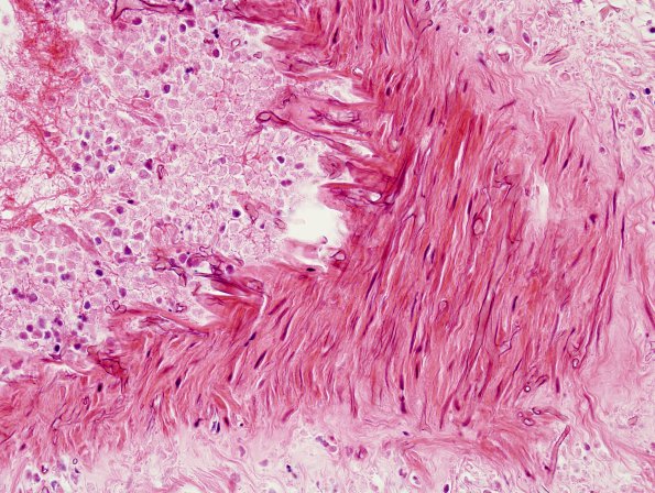 4B2 Mucormycosis (Rhizopus) (Case 4) H&E 16