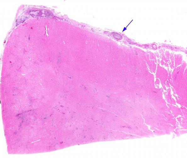 4B3 Mucormycosis (Rhizopus) (Case 4) N11 H&E whole mount copy