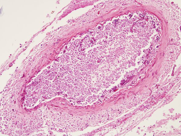 4B4 Mucormycosis (Rhizopus) (Case 4) H&E 7