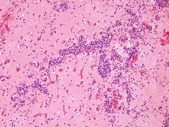 4D1 Mucormycosis (Rhizopus) (Case 4) H&E 4