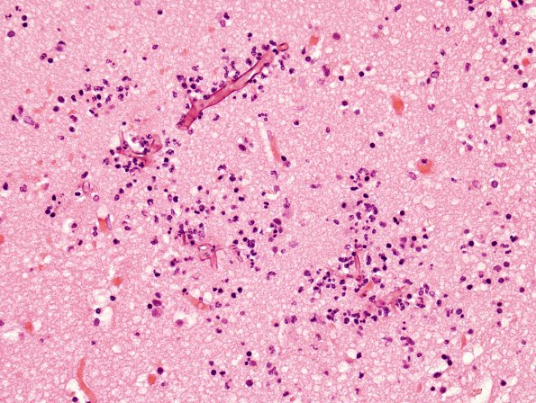 4D2 Mucormycosis (Rhizopus) (Case 4) H&E 5