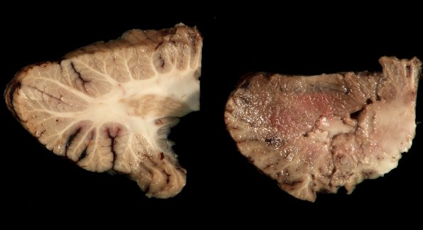 5A Mucormycosis (Case 5) 2