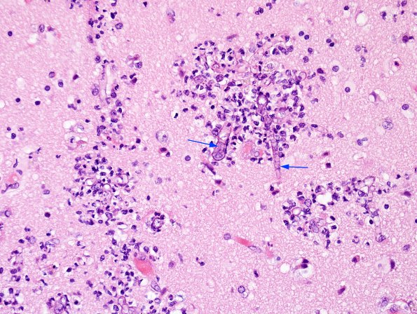 5B1 Mucormycosis (Case 5) H&E 7 copyA