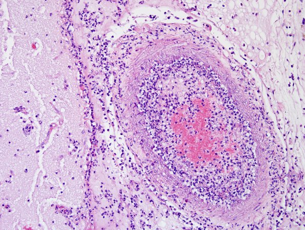 5B2 Mucormycosis (Case 5) N16 H&E 3