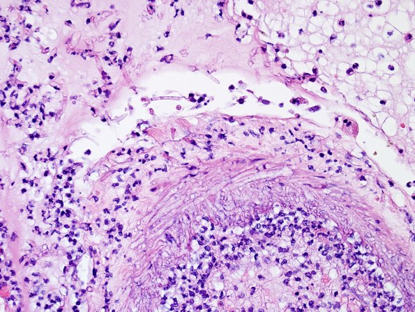 5B3 Mucormycosis (Case 5) N16 H&E 2