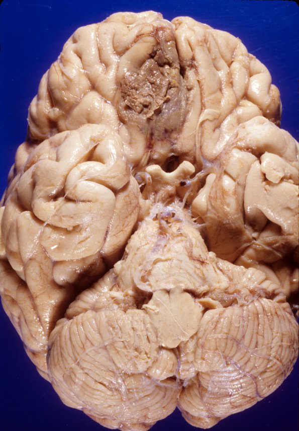 6A1 Mucormycosis (Case 6) gross 3