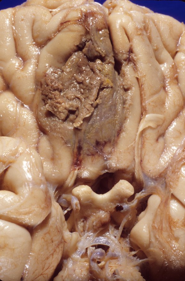 6A2 Mucormycosis (Case 6) gross 2