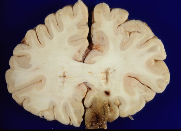 6A3 Mucormycosis (Case 6) gross 1A