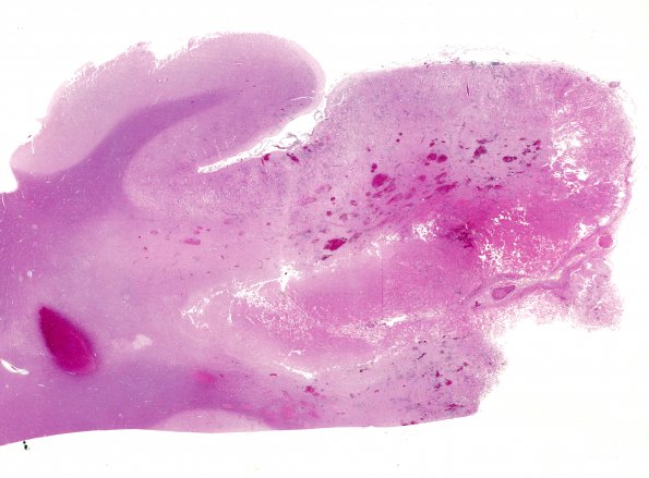 6B1 Mucormycosis (Case 6) H&E whole mount