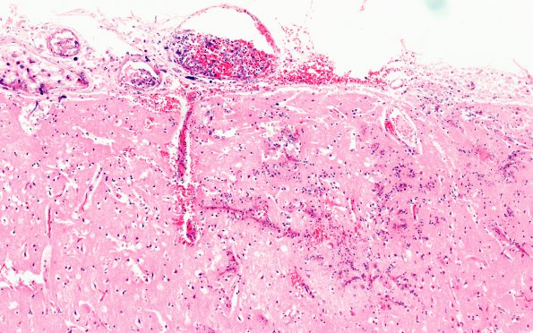 6B2 Mucormycosis (Case 6) H&E 6