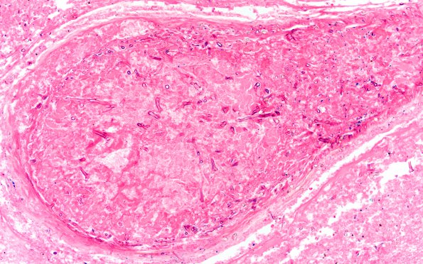 6B3 Mucormycosis (Case 6) H&E 2