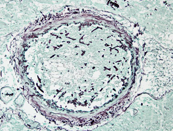 6C1 Mucormycosis (Case 6) GMS 1