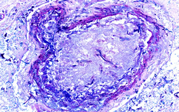 6C3 Mucormycosis (Case 6) LFB-PAS