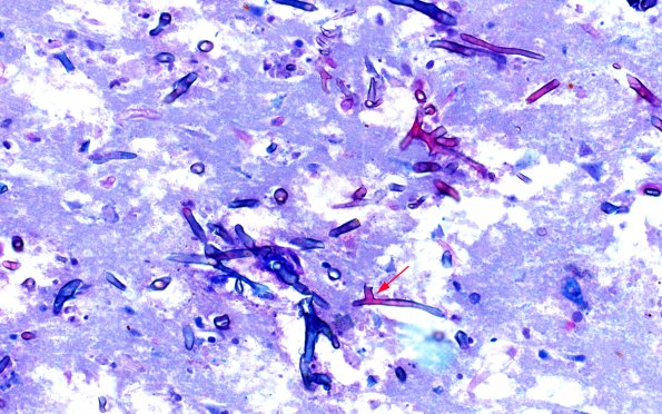 6C4 Mucormycosis (Case 6) LFB-PAS copy A