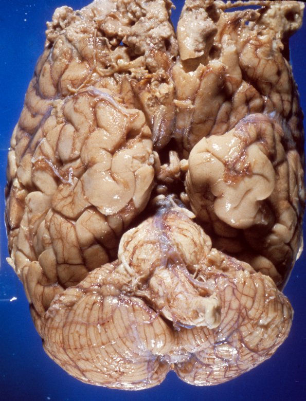 9A1 Mucormycosis (Case 9) 2