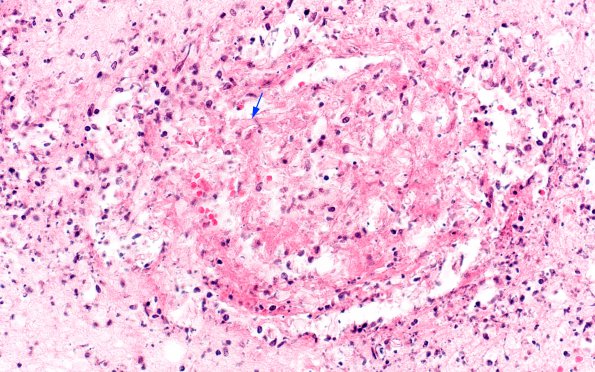 9B Mucormycosis (Case 9) 3 copy